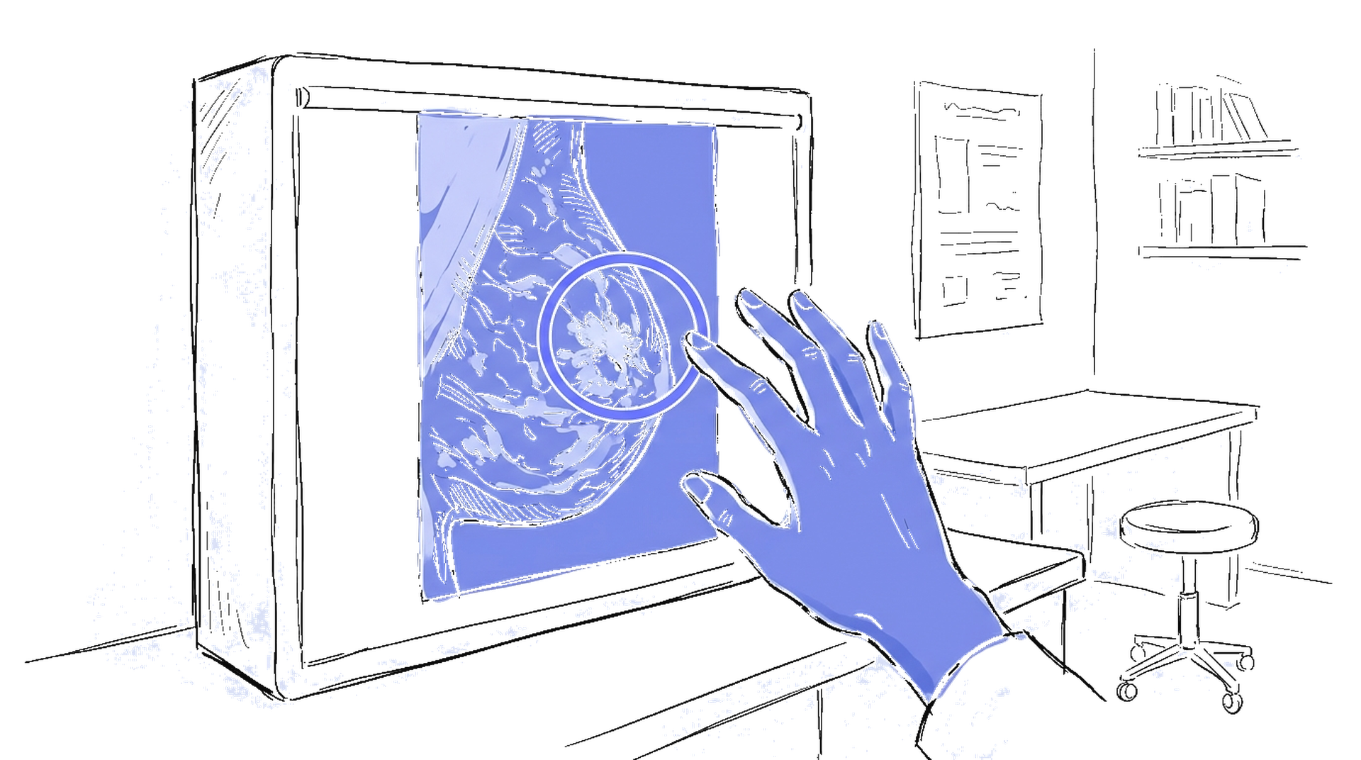 Handgezeichnete Skizze eines Mammogramms mit KI-Overlay-Markierung